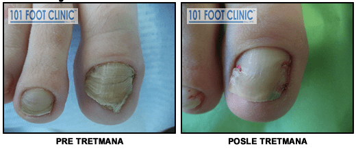 Gljivična infekcija noktiju