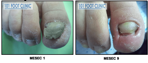 Gljivična Infekcija noktiju