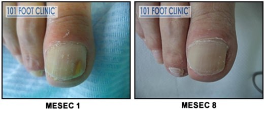 Gljivična Infekcija noktiju