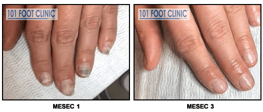 Bakterijska infekcija noktiju