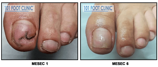 Onihoreksija i urasli nokat