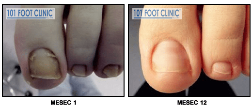 Gljivična infekcija noktiju